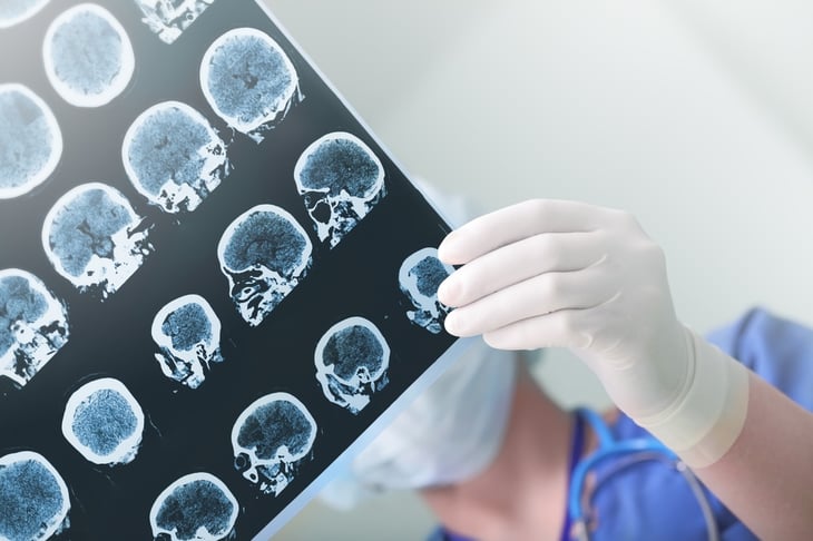 El riesgo de fractura en la epilepsia es mayor en algunos pacientes
