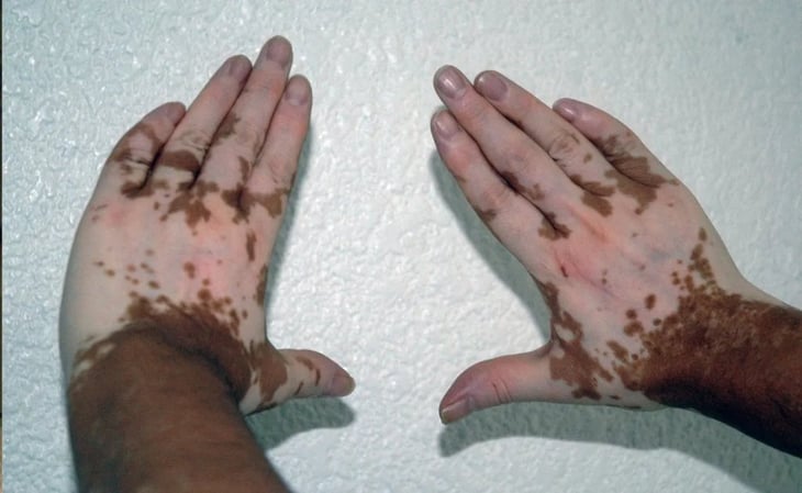 Vitiligo: más de un millón de personas en México, afectadas por esta condición