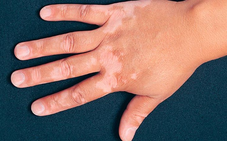 Dificultades diagnósticas para diferenciar liquen escleroso de vitiligo