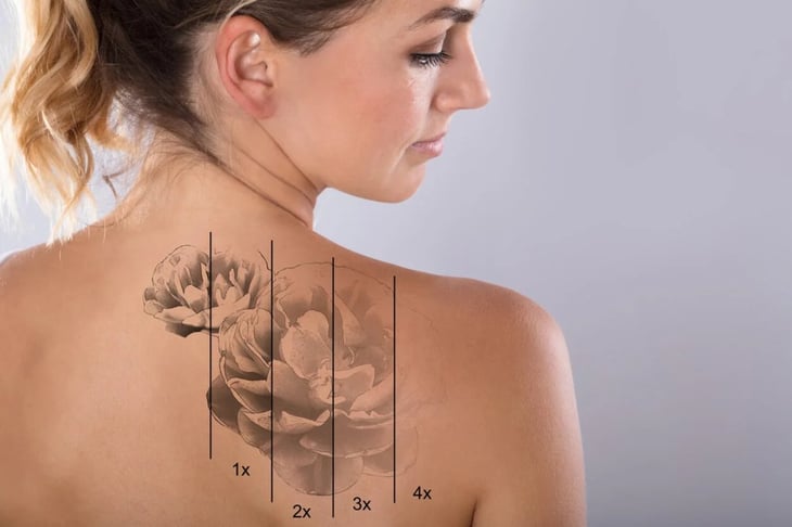 ¿Puede provocar cáncer la eliminación de tatuajes con láser?