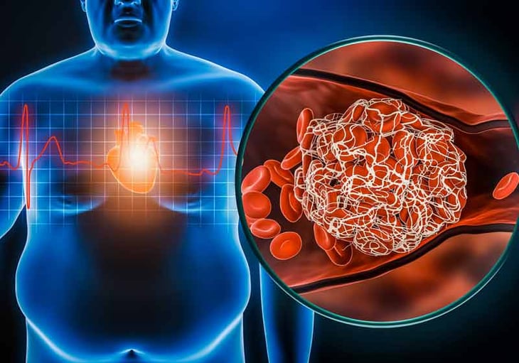El papel de la obesidad y la inflamación en el riesgo cardiometabólico