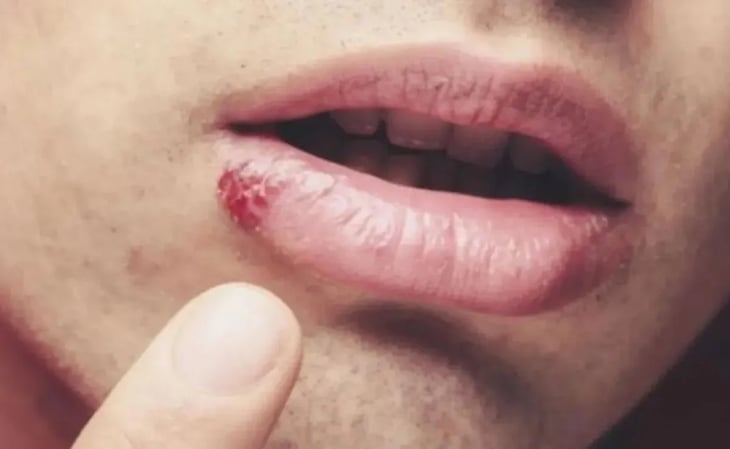 El herpes labial: una infección común y sus formas de transmisión