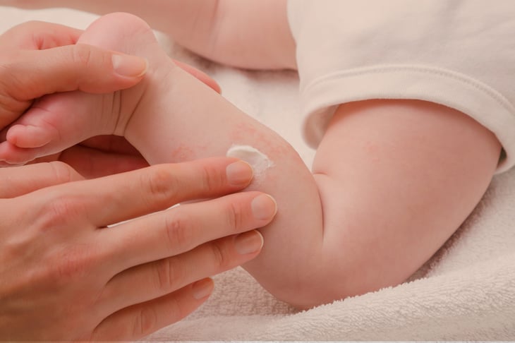 El baño emoliente precoz de los bebés se relaciona con una dermatitis atópica ulterior