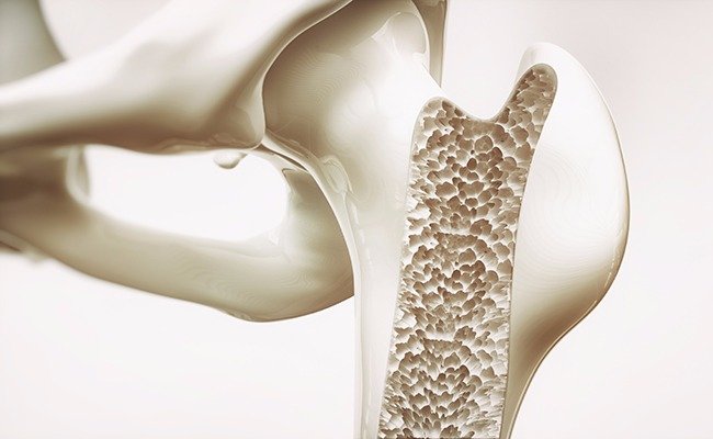 Invitan a la campaña de detección temprana de osteoporosis 