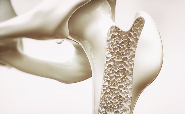 Desarrollo Social invita a la campaña de detección temprana de osteoporosis