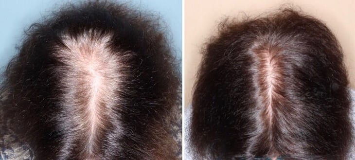 Minoxidil oral para la alopecia androgenética femenina