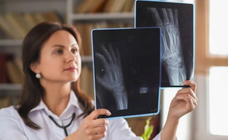 Cómo cuidarse para prevenir fracturas y osteoporosis