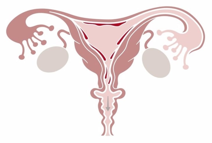 Uso de antiandrógenos en el síndrome de ovario poliquístico