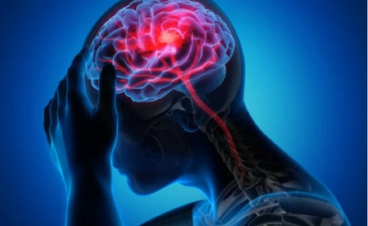 Cuáles son los síntomas de un derrame cerebral