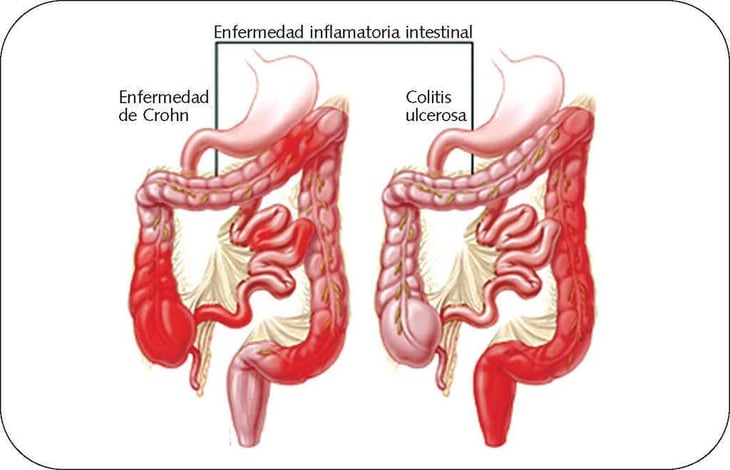 La definición de enfermedad inflamatoria intestinal de difícil tratamiento