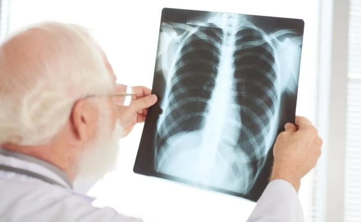 Signos y síntomas de la tuberculosis que debes conocer para detectarla a tiempo