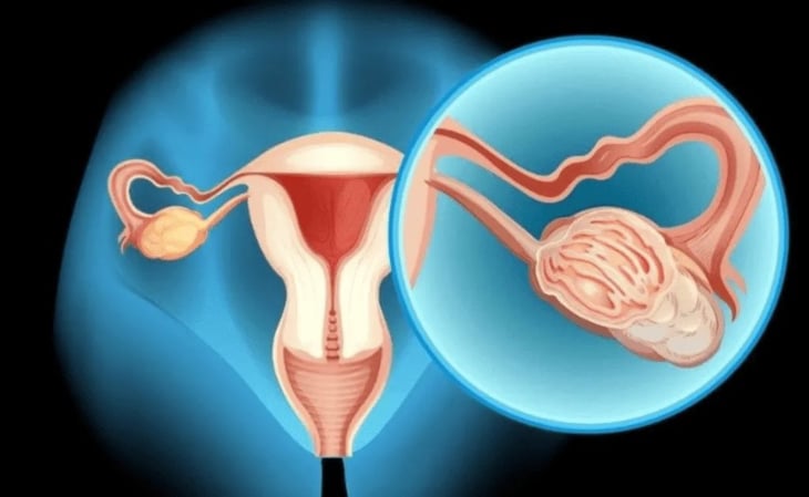 Frenar recurrencia y concienciar a mujeres, retos contra el cáncer de ovario