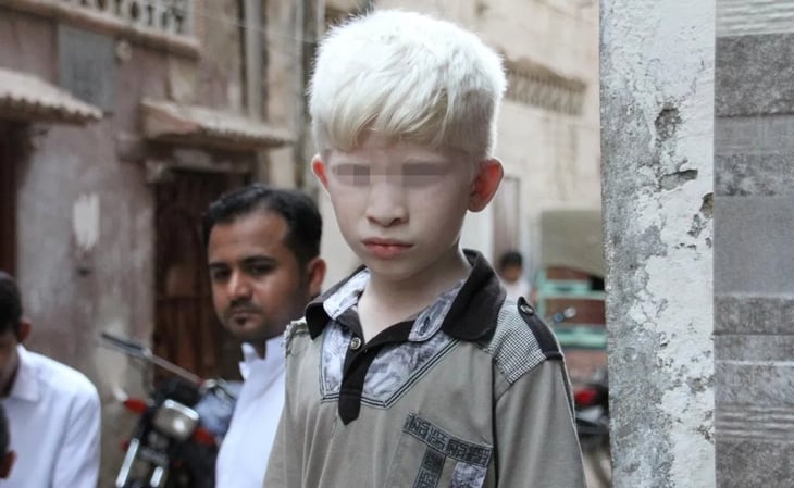 Cómo deben cuidar la piel las personas con albinismo