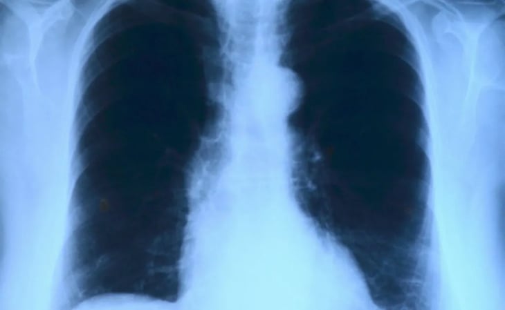 ¿Por qué se complica la hipertensión pulmonar?