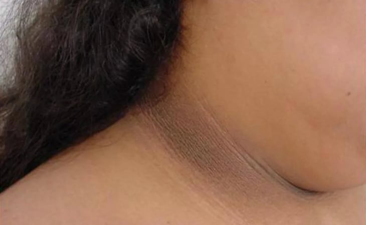 ¿Qué son las manchas oscuras alrededor del cuello?