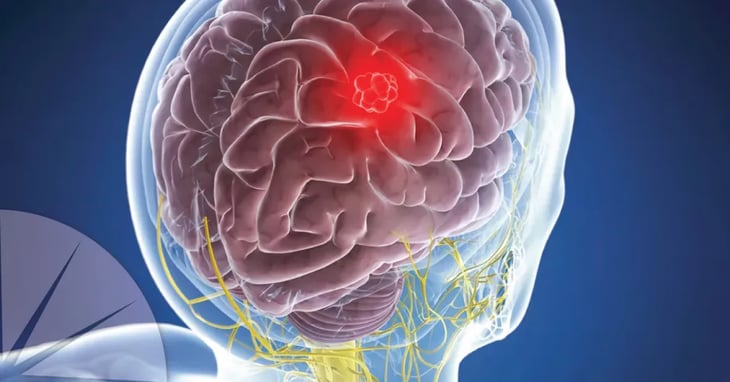Las metástasis cerebrales podrían interferir en los circuitos neuronales