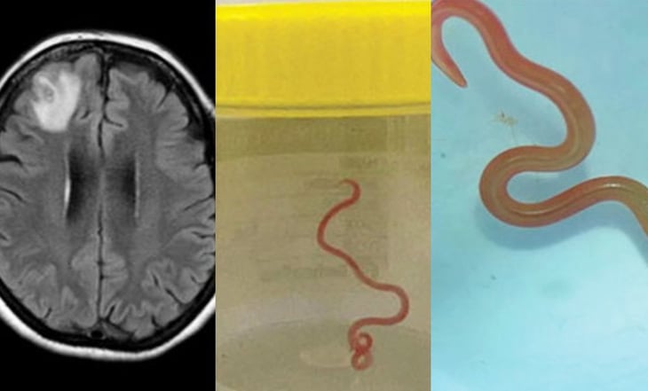 Se extrae nematodo vivo del cerebro de un paciente en un caso sorprendente