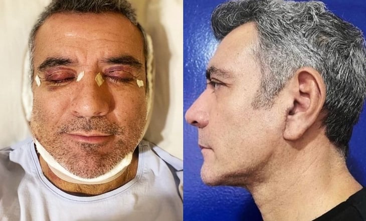Héctor Sandarti se despide de los párpados caídos y la papada tras someterse a cirugía estética