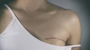 Datos 'tranquilizadores' sobre la radiación parcial en cáncer de mama
