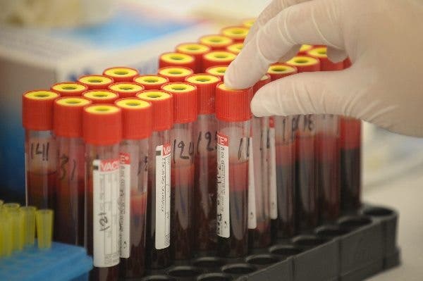 Trombocitopenia inmune: Cuando las plaquetas de la sangre están demasiado bajas