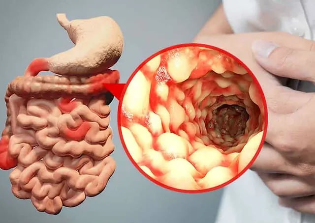 Remisión endoscópica se duplica con risankizumab en enfermedad de Crohn