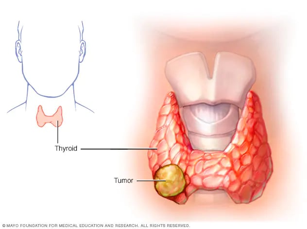 La edad al diagnóstico predice el resultado del cáncer diferenciado de tiroides