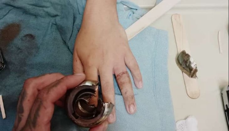 Bombero salva el dedo de un menor atorado en una chapa