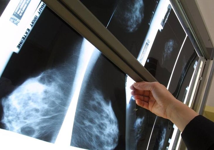 Haber tenido un falso positivo en un mamografía eleva el riesgo de cáncer de mama