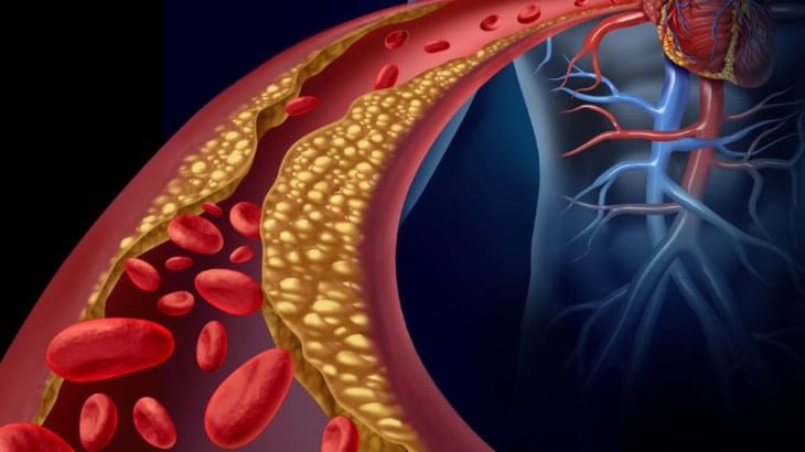 La prevención primaria es el gran efecto para reducir la morbimortalidad cardiovascular