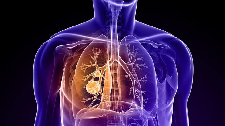 Cáncer de pulmón afecta a personas jóvenes, las mujeres enfrentan un riesgo más alto que los hombres