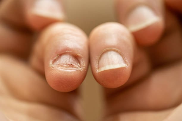 Consejos simples para dejar de morderte las uñas