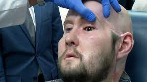 Hospital de Nueva York logra primer trasplante de un ojo entero en operación de 21 horas
