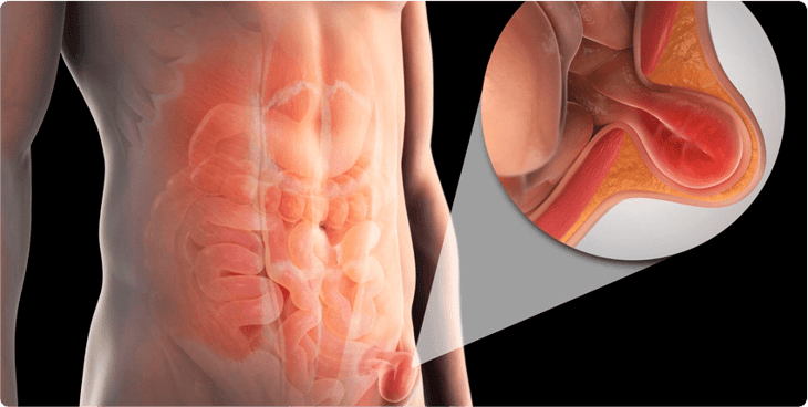 Dolor de pared abdominal: solo se diagnostica lo que se conoce