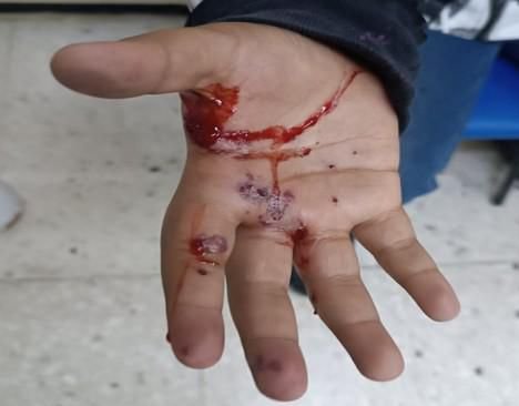 Menor sufre una herida al explotarle un cuete en la mano