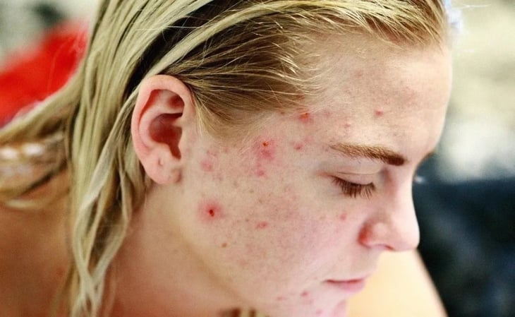¿El jabón Zote puede ayudar a prevenir el acné?