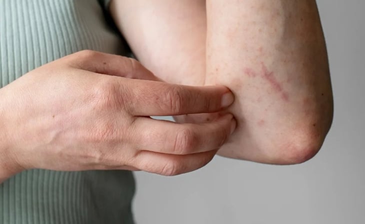 Dengue: ¿Cómo tratar la comezón de sarpullido en la piel?