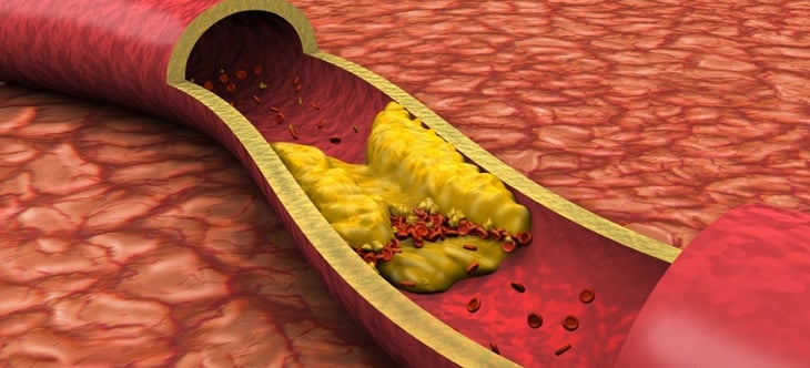 El riesgo letal del 'colesterol malo' que la mayoría de la gente no toma en cuenta