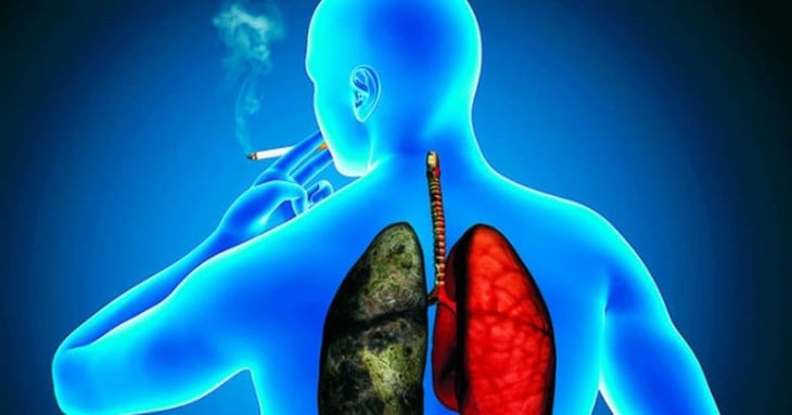 La tasa de casos nuevos de cáncer de pulmón ha disminuido en los últimos cinco años