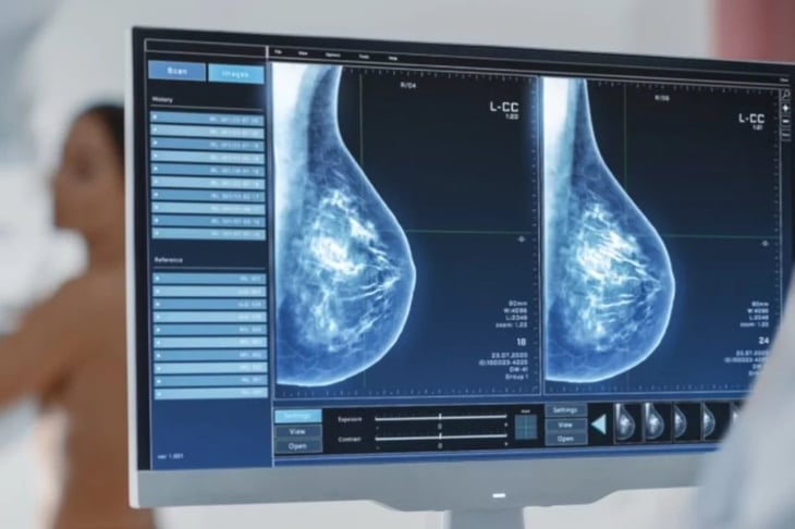 Los falsos positivos en las mamografías se relacionan con más riesgo de cáncer de mama a largo plazo