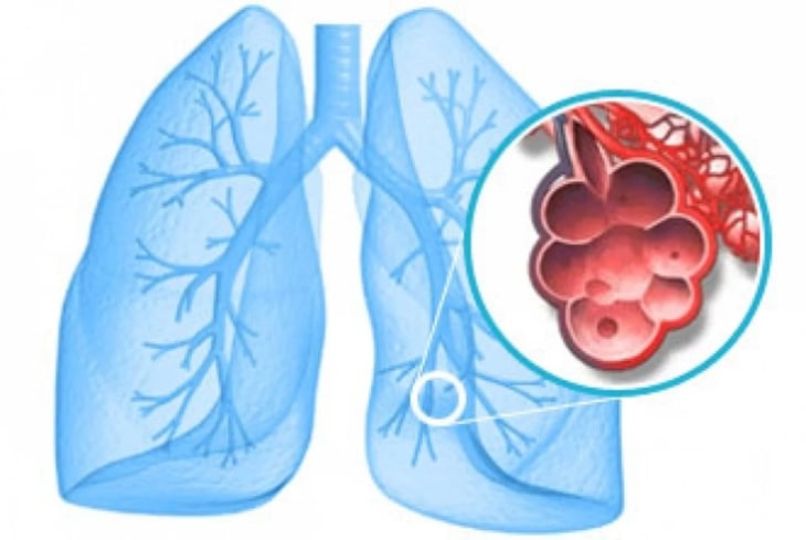 Cáncer de pulmón: por qué aumentaron los casos y la mortalidad en las mujeres