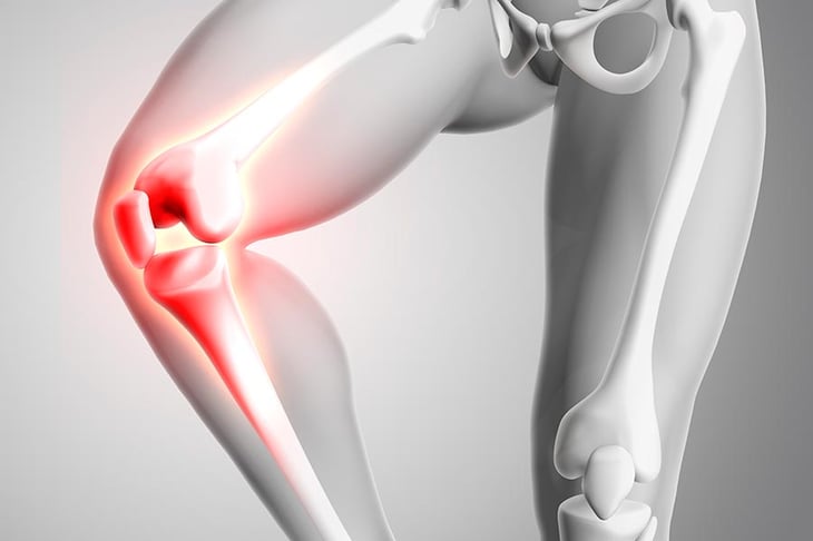 ¿Quieres evitar la artroplastia de rodilla? Fortalece tus muslos