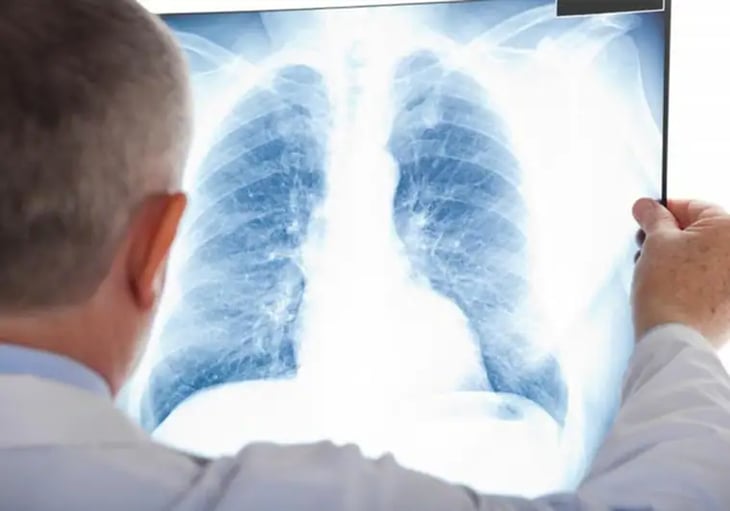 Esta proteína clave en propagar cáncer de pulmón ya puede controlarse