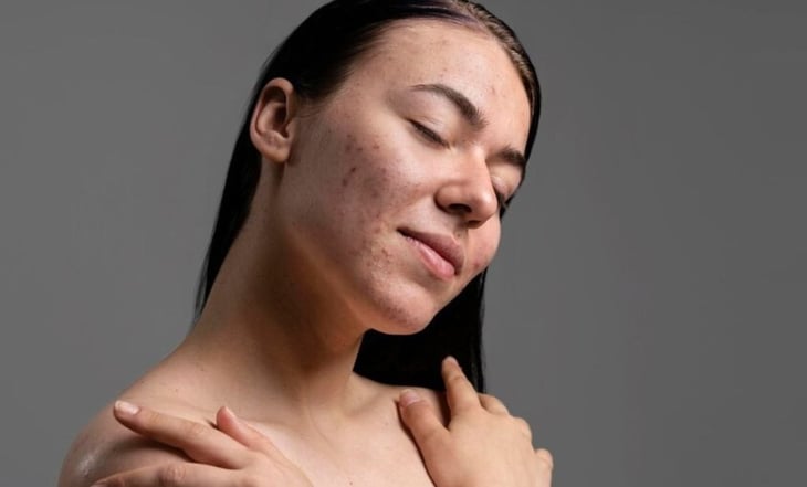 Conoce cómo tratar las cicatrices de acné en tu piel