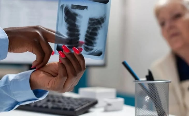 Cáncer de pulmón, más de 7 mil fallecimientos en México por este cáncer