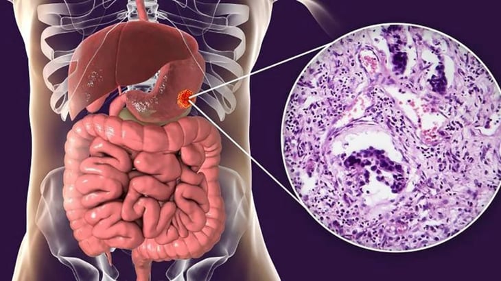 ¿Cómo es y cuáles son los síntomas del cáncer de estómago?