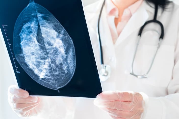 ¿Pueden las sobrevivientes de cáncer de mama reducir la frecuencia de las mamografías?