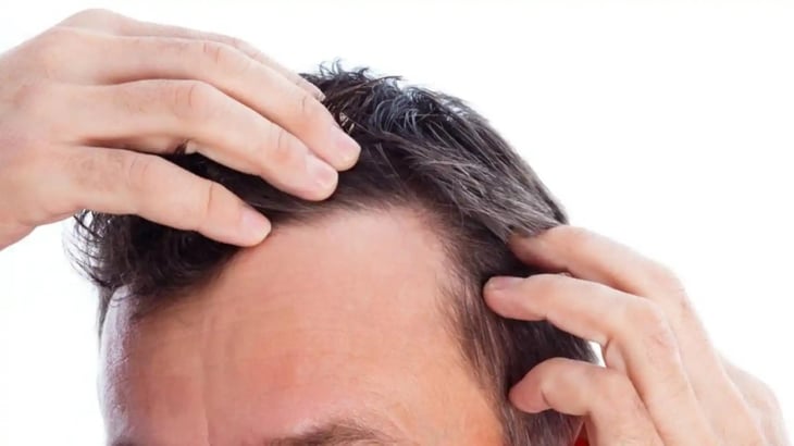¿Cuáles son las vitaminas esenciales para evitar la caída de cabello?