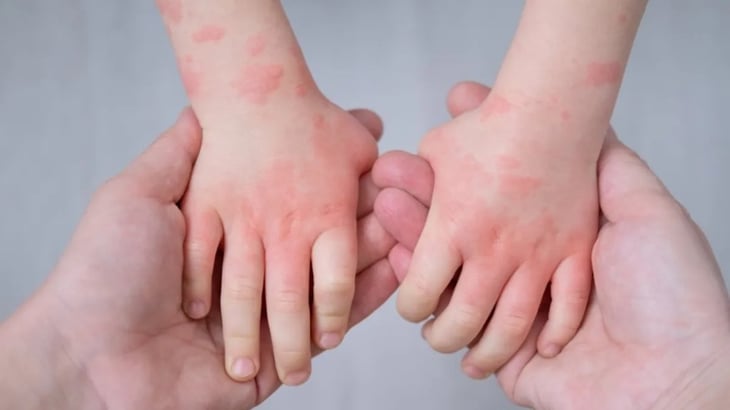 Los niños con eczema podrían necesitar más pruebas de alergia