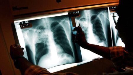Aumento de casos de tuberculosis se han detectado en  PN