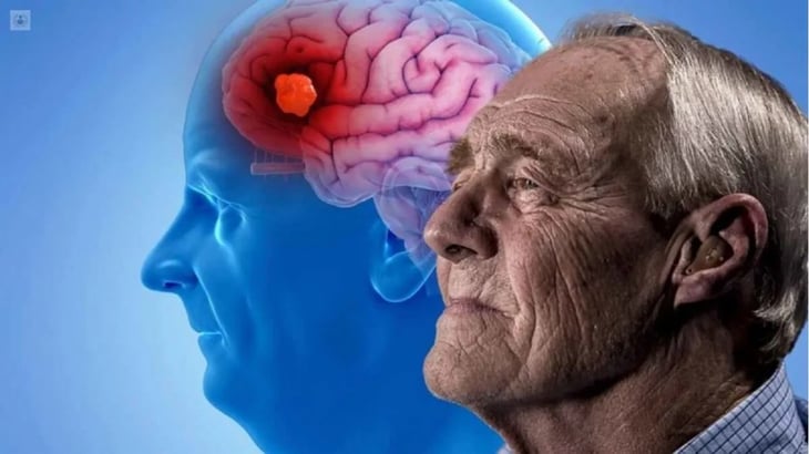 Enfermedad de Alzheimer: además de los virus, ahora también se sospecha de una bacteria